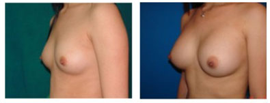 Breast Implants, Breast Augmentation, Mammoplasty