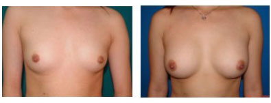 Breast Implants, Breast Augmentation, Mammoplasty